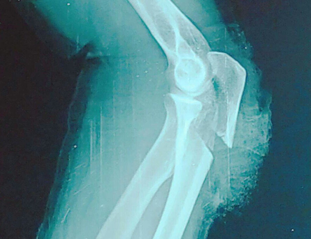 Đang ăn cơm bị kẻ lạ mặt xông vào nhà chém gần lìa cánh tay ảnh 1