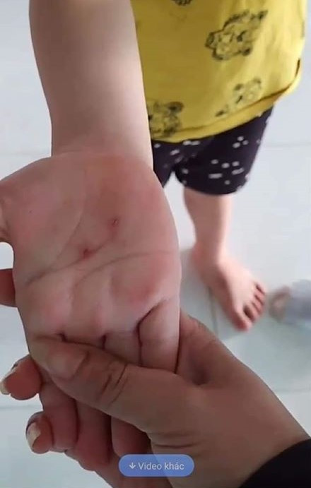 Buộc thôi việc giáo viên dùng vật nhọn đâm tay trẻ ảnh 2