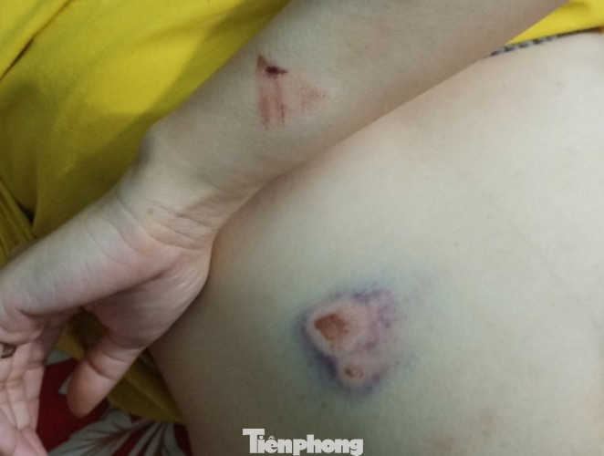 Thai phụ bị đánh hội đồng phải nhập viện cấp cứu ảnh 2