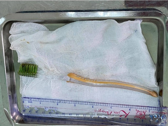 Bé trai 13 tuổi suýt chết vì nuốt bàn chải đánh răng vào bụng ảnh 1