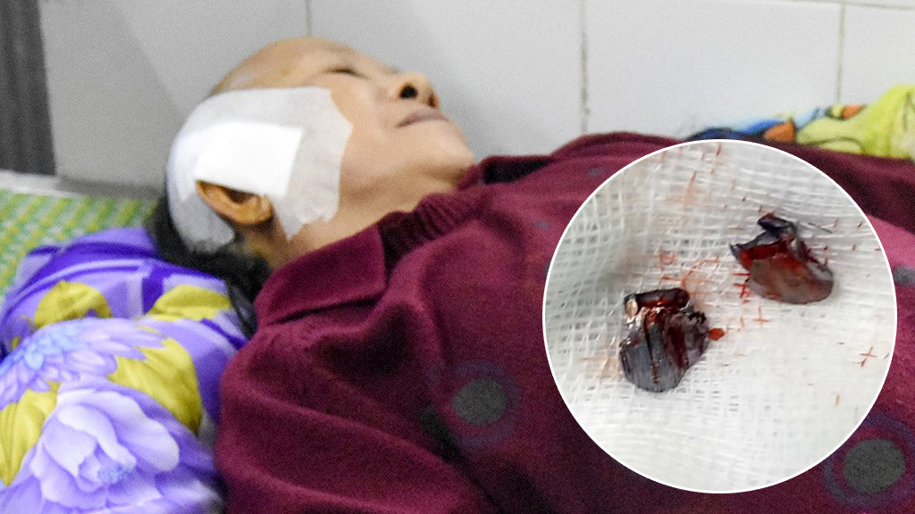 Đạn găm trúng đầu người phụ nữ ảnh 1