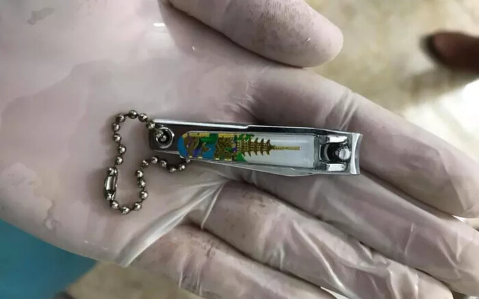 Phú Thọ: Bé gái 9 tuổi học theo clip trên YouTube nuốt bấm móng tay vào bụng ảnh 2