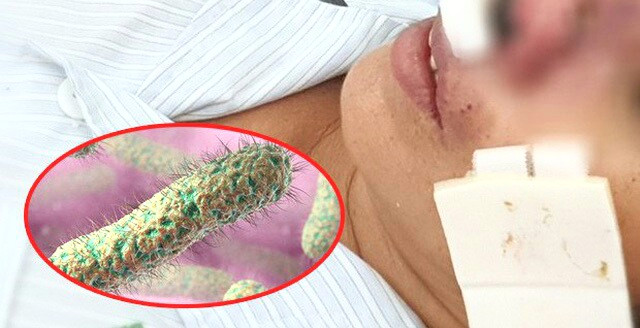 9 bệnh nhân mắc bệnh ‘vi khuẩn ăn thịt người’ Whitmore ảnh 1