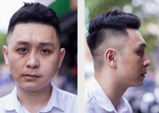 'Giải cứu' mũi lệch vẹo vách ngăn cho vị bác sĩ trẻ 10 năm bị khó thở ảnh 1