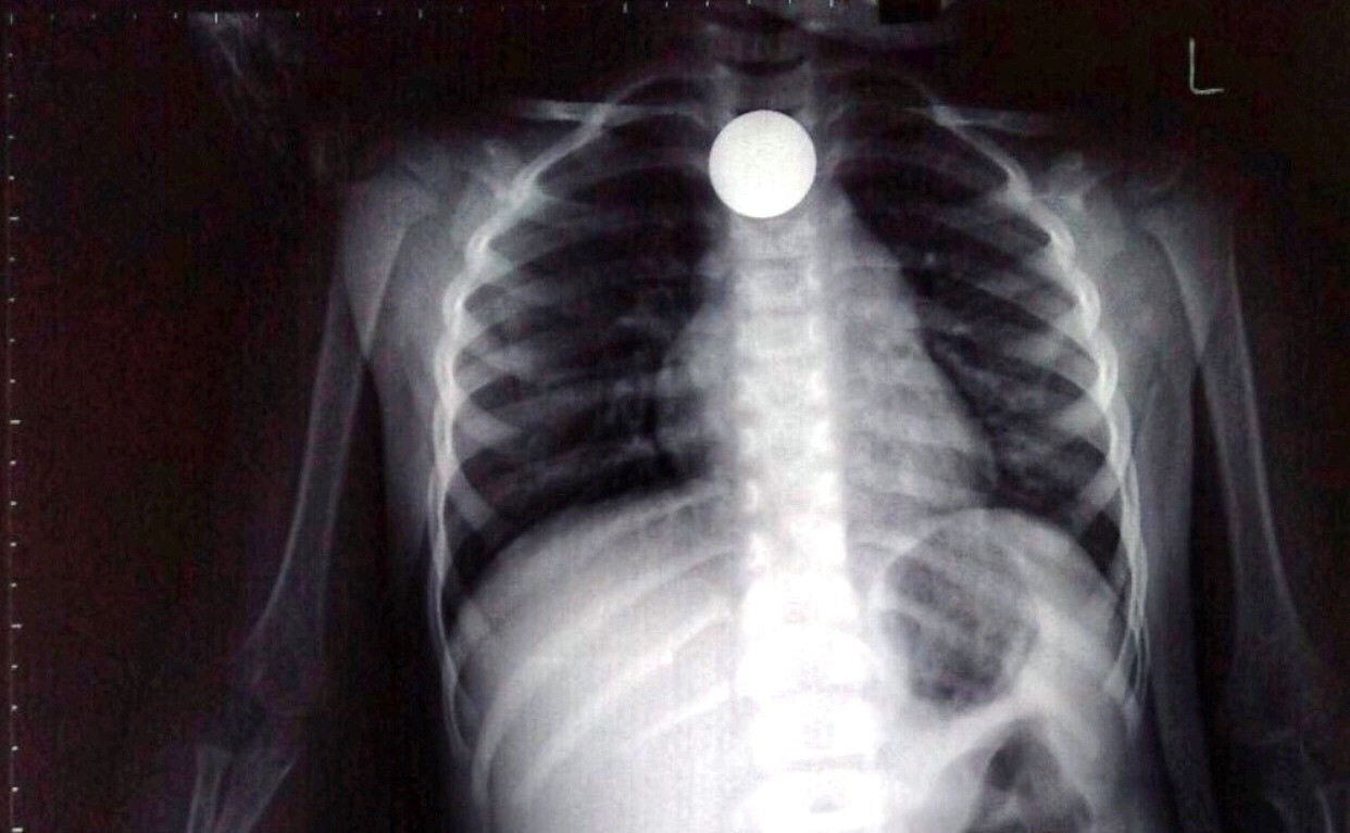 Cứu bé 3 tuổi bị đồng xu mắc chẹn ngang thực quản ảnh 1