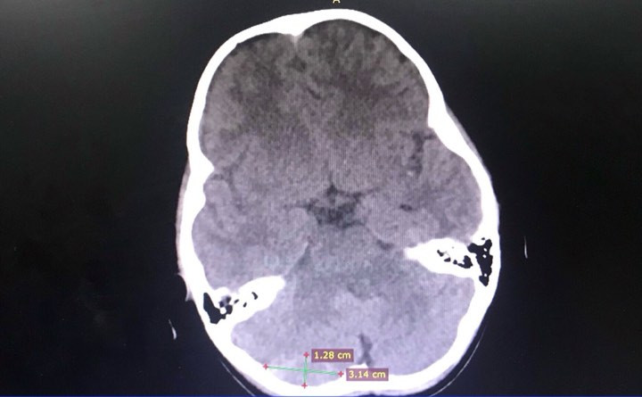 Bé gái suýt chết vì chấn thương sọ não do cha mẹ chủ quan ảnh 1