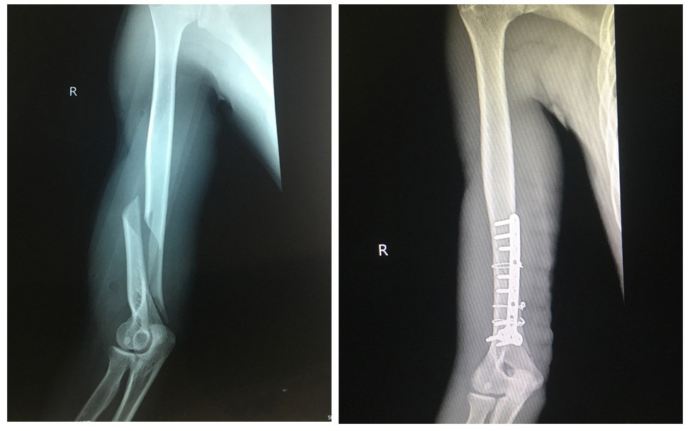 Chơi vật tay với bạn, thanh niên 19 tuổi bị gãy xương cánh tay ảnh 1