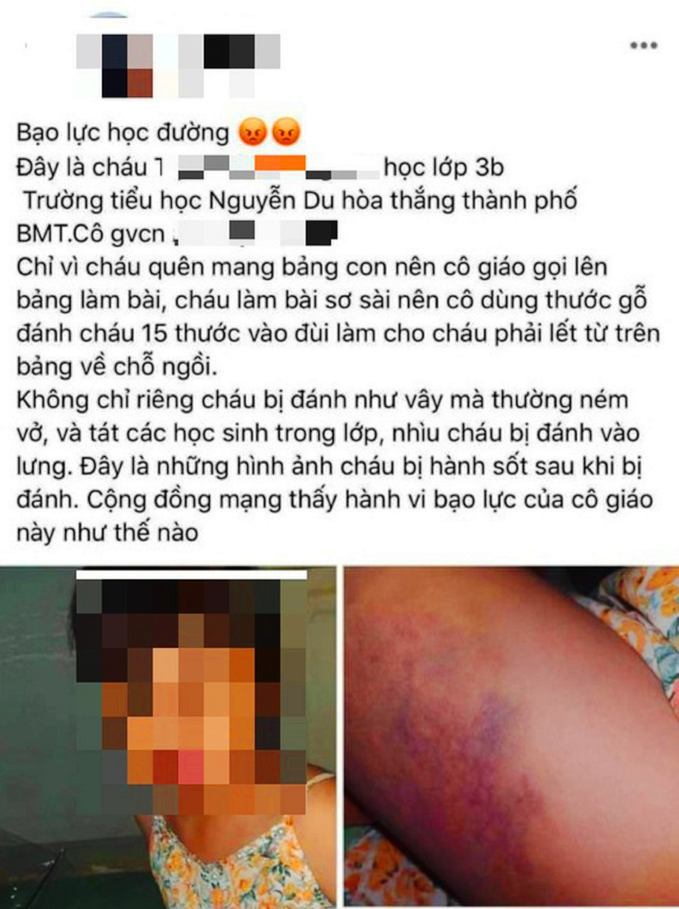 Đánh học sinh lớp 3 tím đùi, cô giáo bị tạm đình chỉ dạy ảnh 1