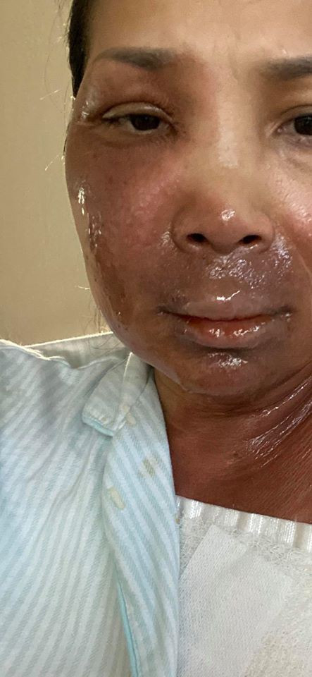 Hồng Ngọc khoe ảnh mặt mộc sau sự cố nổ nồi hơi gây biến dạng tại Mỹ ảnh 2