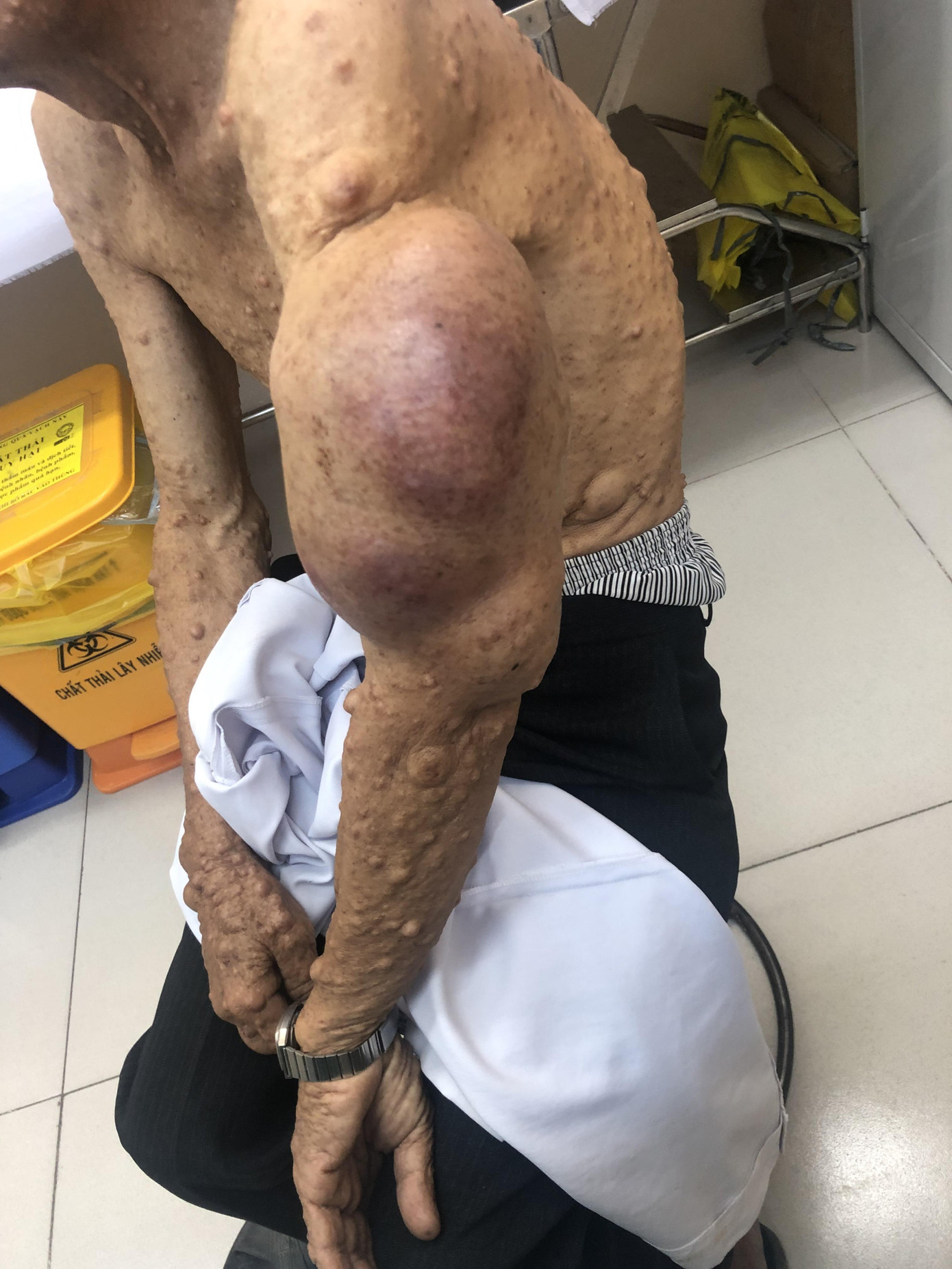 Cứu thầy giáo thoát cảnh mặc quần 'mỗi ống 1 size' vì khối bướu khổng lồ ảnh 2