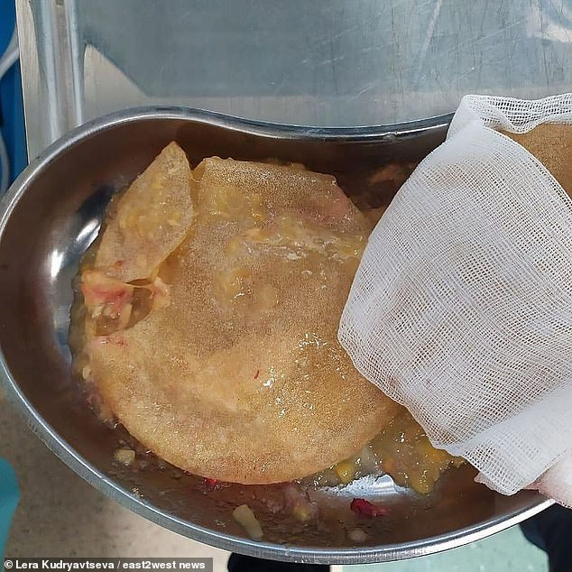 Nữ MC truyền hình bị vỡ túi ngực 15 năm, phải phẫu thuật khẩn cấp ảnh 1