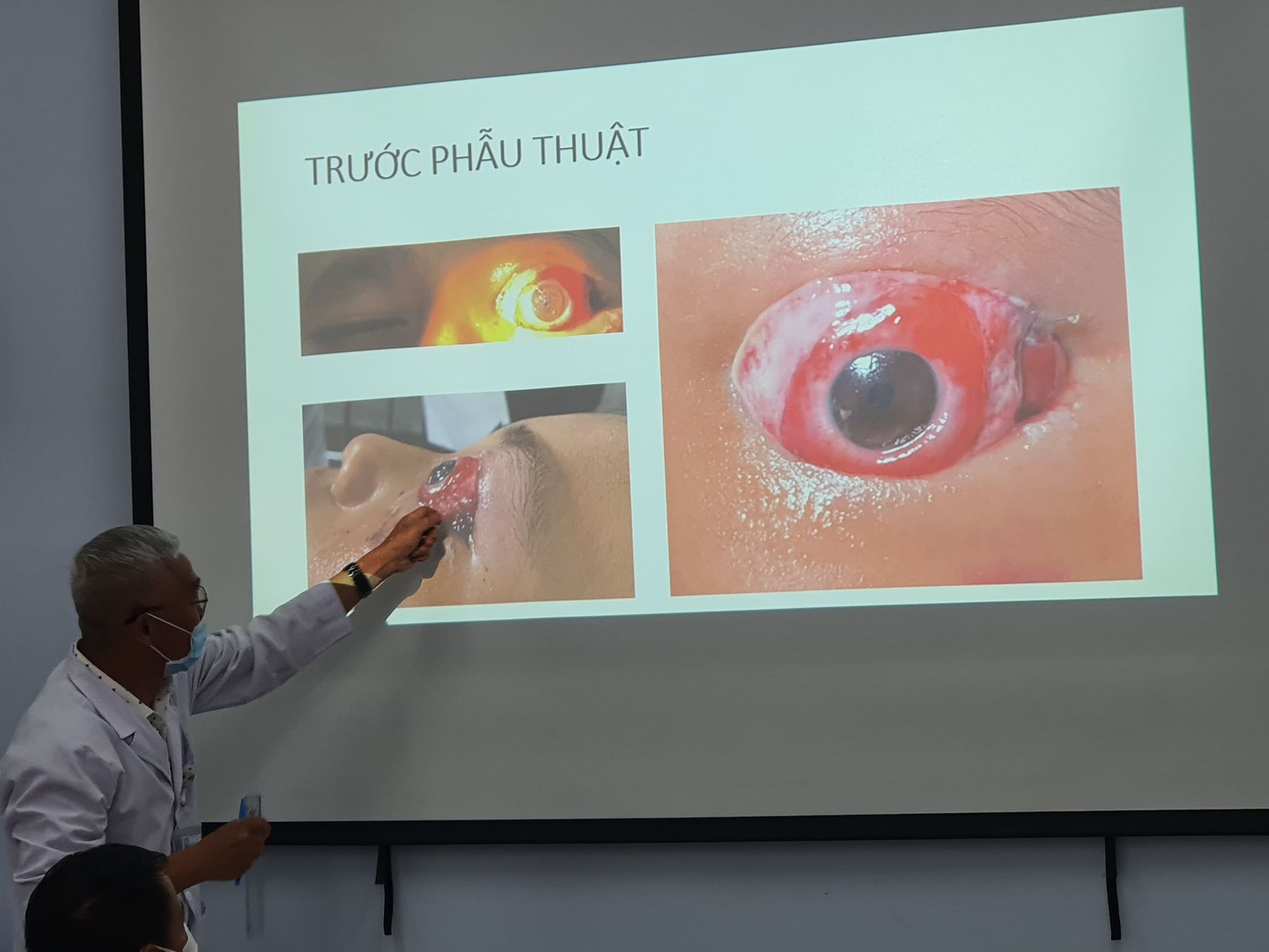 Bé trai 9 tuổi bị tay lái xe đạp đập lồi mắt khiến nhiều bệnh viện 'bó tay' ảnh 1