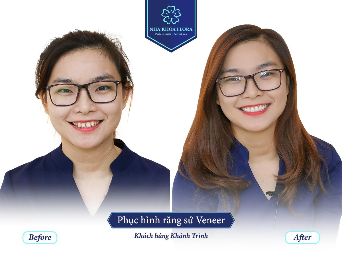 Cách nhận biết răng sứ chính hãng và răng sứ kém chất lượng ảnh 1