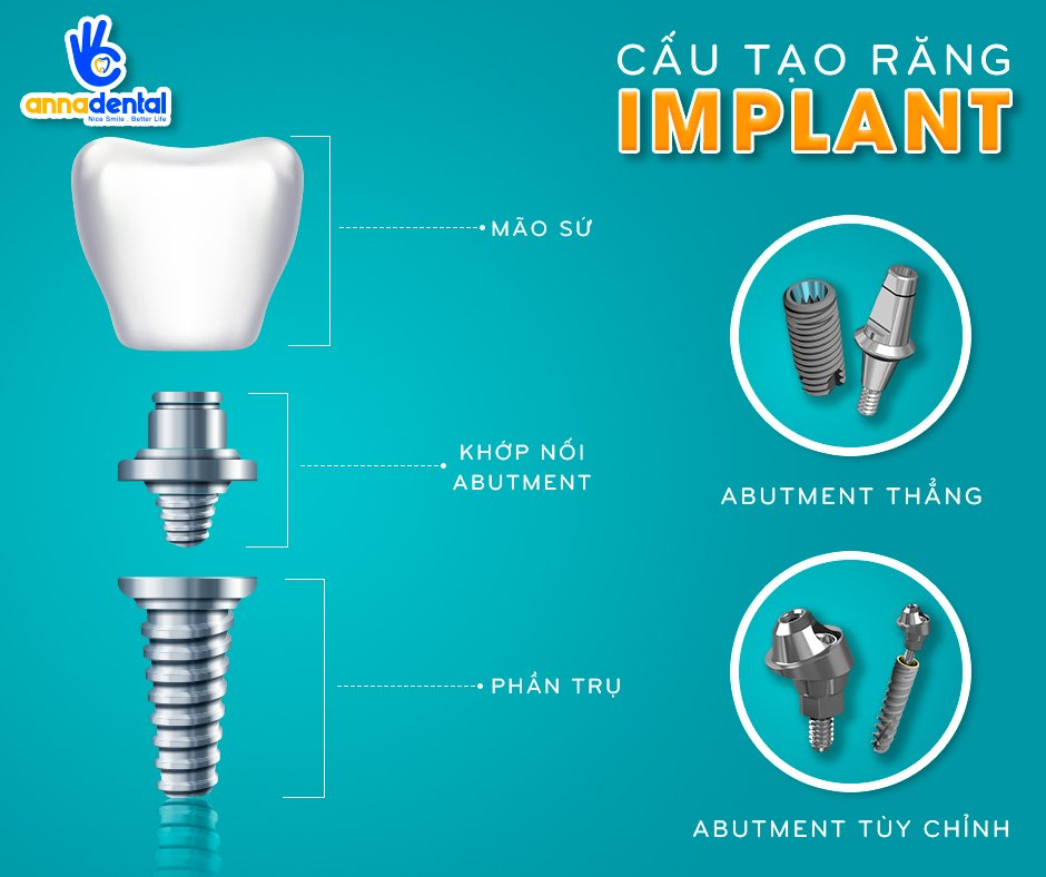 Biện pháp hiện đại cho người lớn tuổi mất răng từ Nha khoa Anna ảnh 3