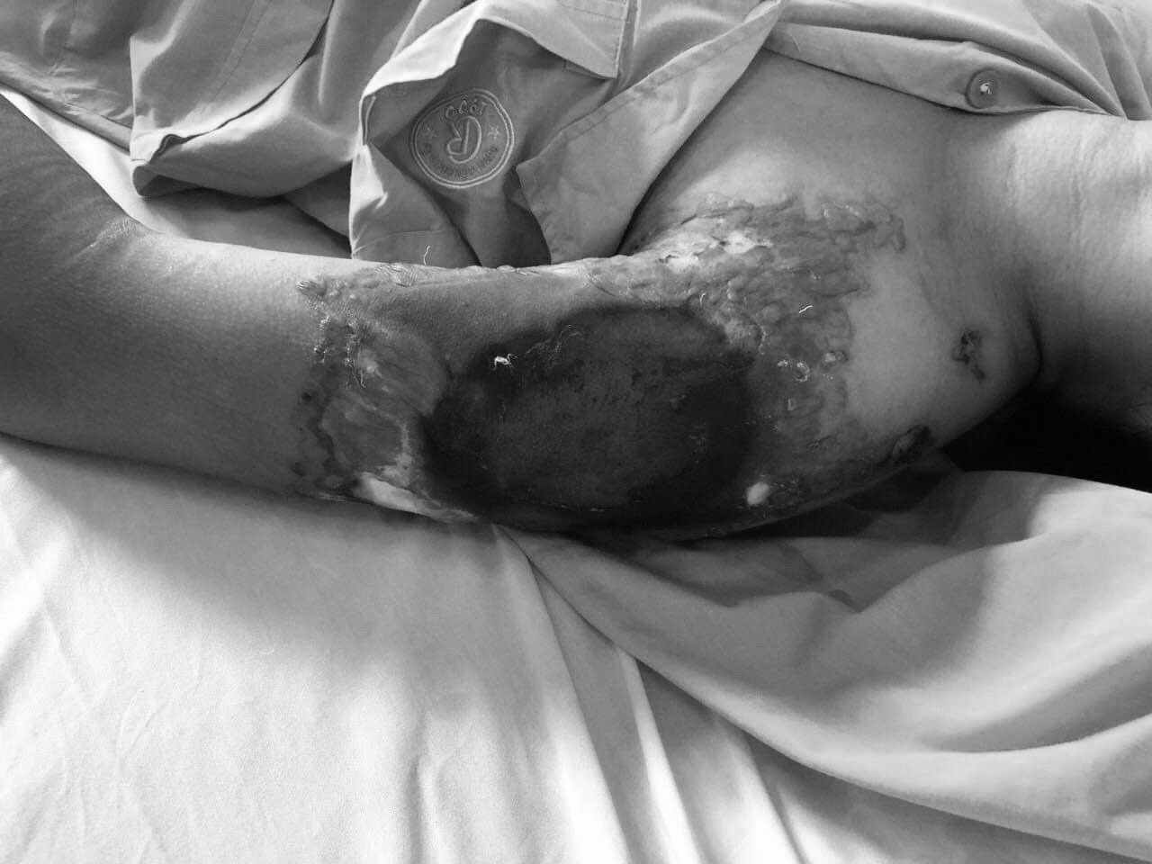 Sản phụ bị bỏng mất cả bàn tay vì nằm than sau sinh ảnh 1