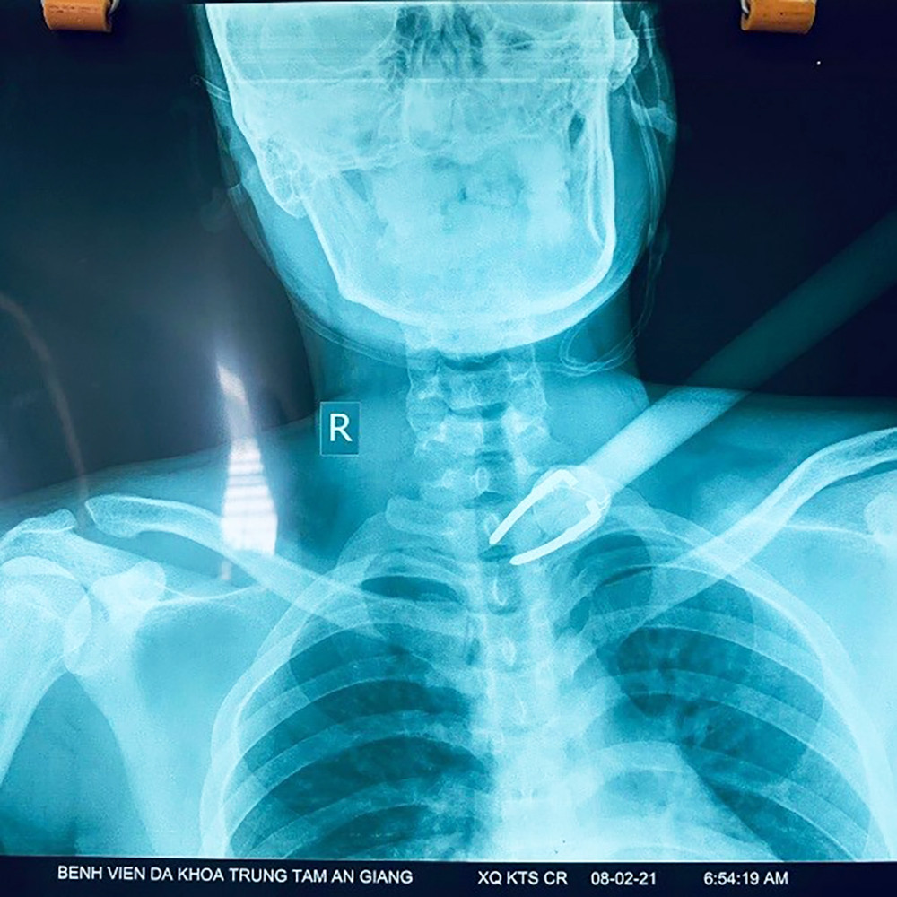 Đuổi theo kẻ trộm chó, nam sinh viên bị bắn tên xuyên cổ ảnh 1