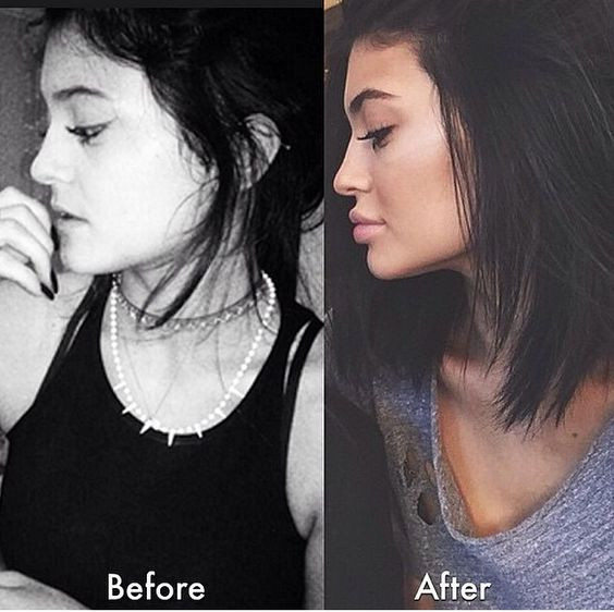 Nhiều người đổ lỗi cho trào lưu bơm môi là tại Kylie Jenner. Tại sao mọi người đều tiêm filler làm đầy môi? Những khao khát dấu đằng sau mốt môi dày ảnh 3
