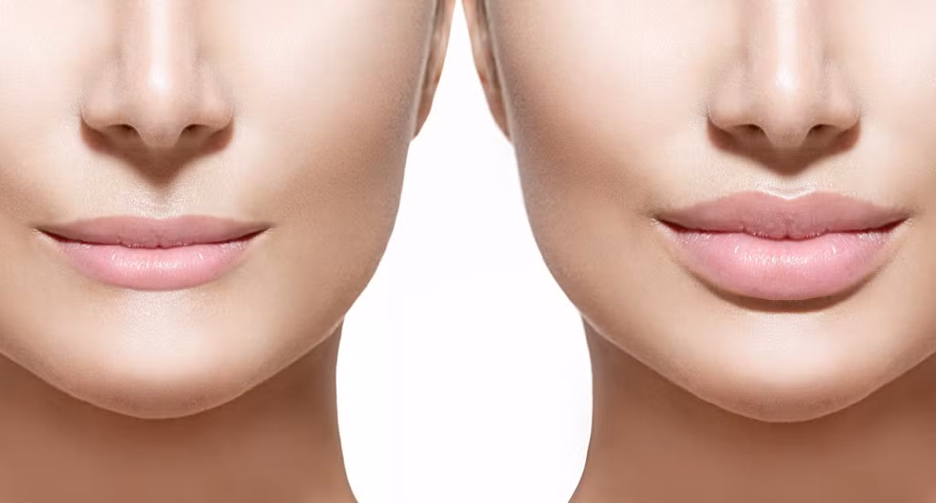 Tại sao mọi người đều tiêm filler làm đầy môi? Những khao khát dấu đằng sau mốt môi dày ảnh 2