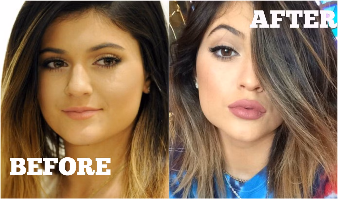 Tại sao mọi người đều tiêm filler làm đầy môi? Những khao khát dấu đằng sau mốt môi dày ảnh 4