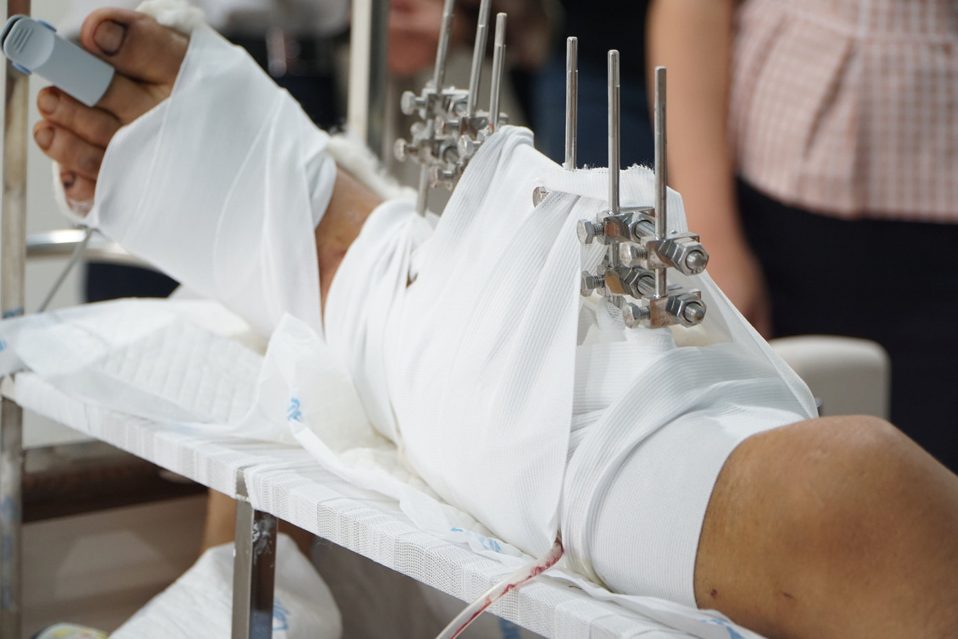 Vừa trả lời dứt câu hỏi, người đàn ông bị hai thanh niên lạ mặt chém gần đứt lìa chân ảnh 1