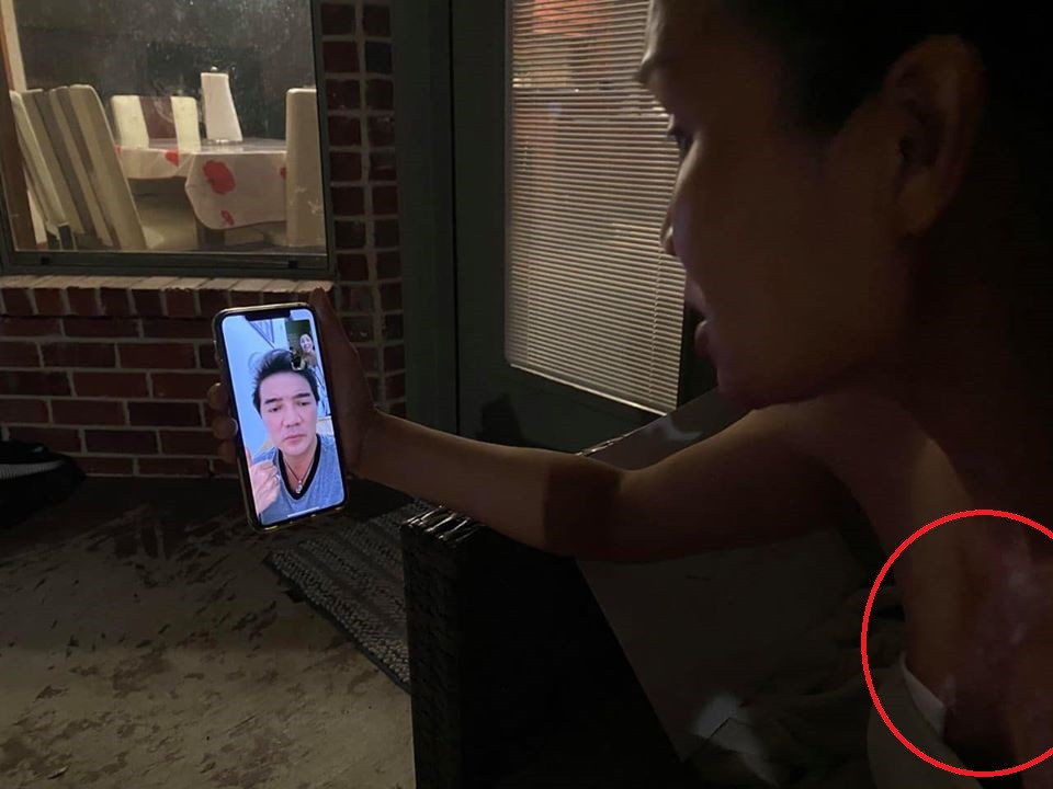 Hồng Ngọc lộ gương mặt biến dạng vì bỏng nặng khiến dân mạng xót xa ảnh 3