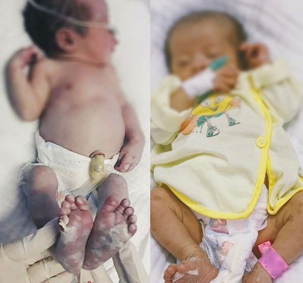 Chữa thành công bé sơ sinh nhiễm bệnh giang mai ảnh 1