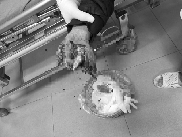 Nghịch pháo, hai anh em bị nổ nát bàn tay ảnh 1