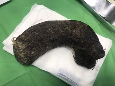 Búi tóc nặng 1kg ở trong dạ dày bé gái 11 tuổi ảnh 1