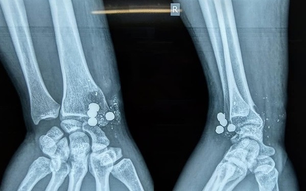 Nghịch súng kíp, nam thanh niên bị 5 viên đạn bắn trúng tay ảnh 1