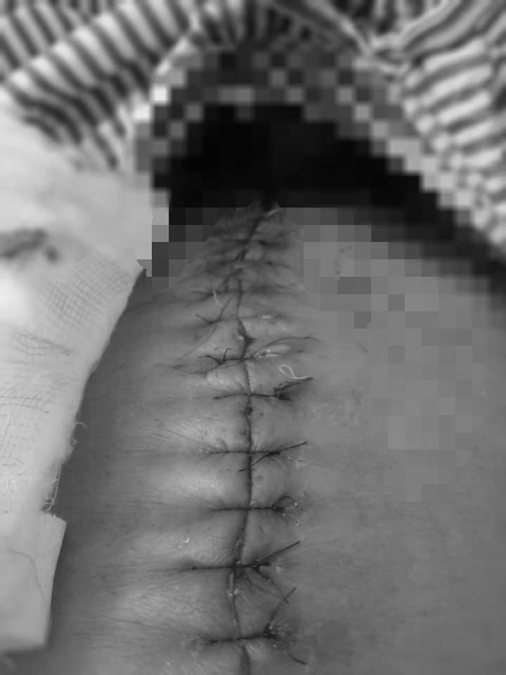 Đi rút ống thông tiểu sau tán sỏi, bác sĩ làm rách niệu đạo bệnh nhân ảnh 2