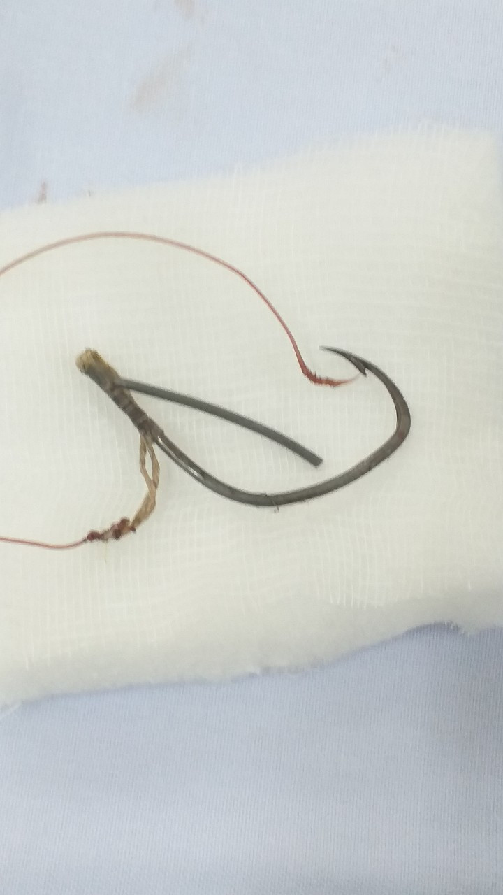 Tổn thương thị lực tới 99% vì bị lưỡi câu móc trúng mắt khi đi câu cá ảnh 1