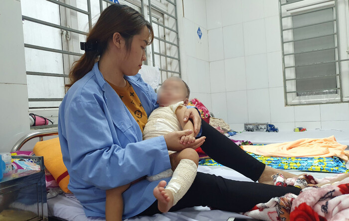 Đắp thuốc chữa bỏng của thầy lang, bé trai 13 tháng tuổi bị hoại tử da ảnh 1