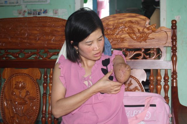 Xót xa cảnh cô giáo mất đi cánh tay trong lần băng rừng 'gieo chữ' ảnh 1