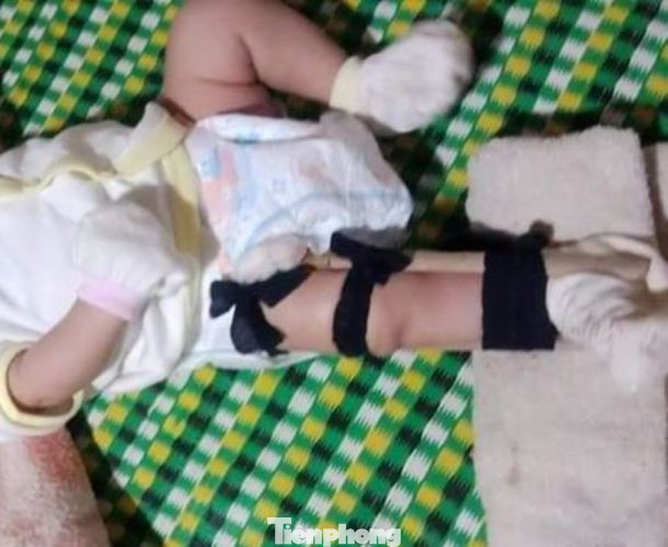 Thực hư cha đạp gãy chân bé sơ sinh vì 'quấy khóc' ảnh 1