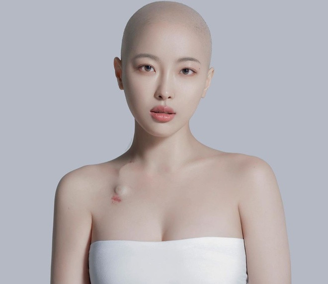 Hot girl 1 năm chống chọi ung thư bằng nụ cười: “Mọi chuyện sẽ tốt thôi, tóc sẽ mọc lại“ ảnh 1