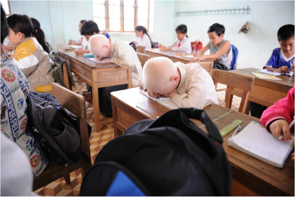 Cặp anh em bạch tạng hiếm hoi: Sự khác biệt chưa bao giờ là trở ngại ảnh 4