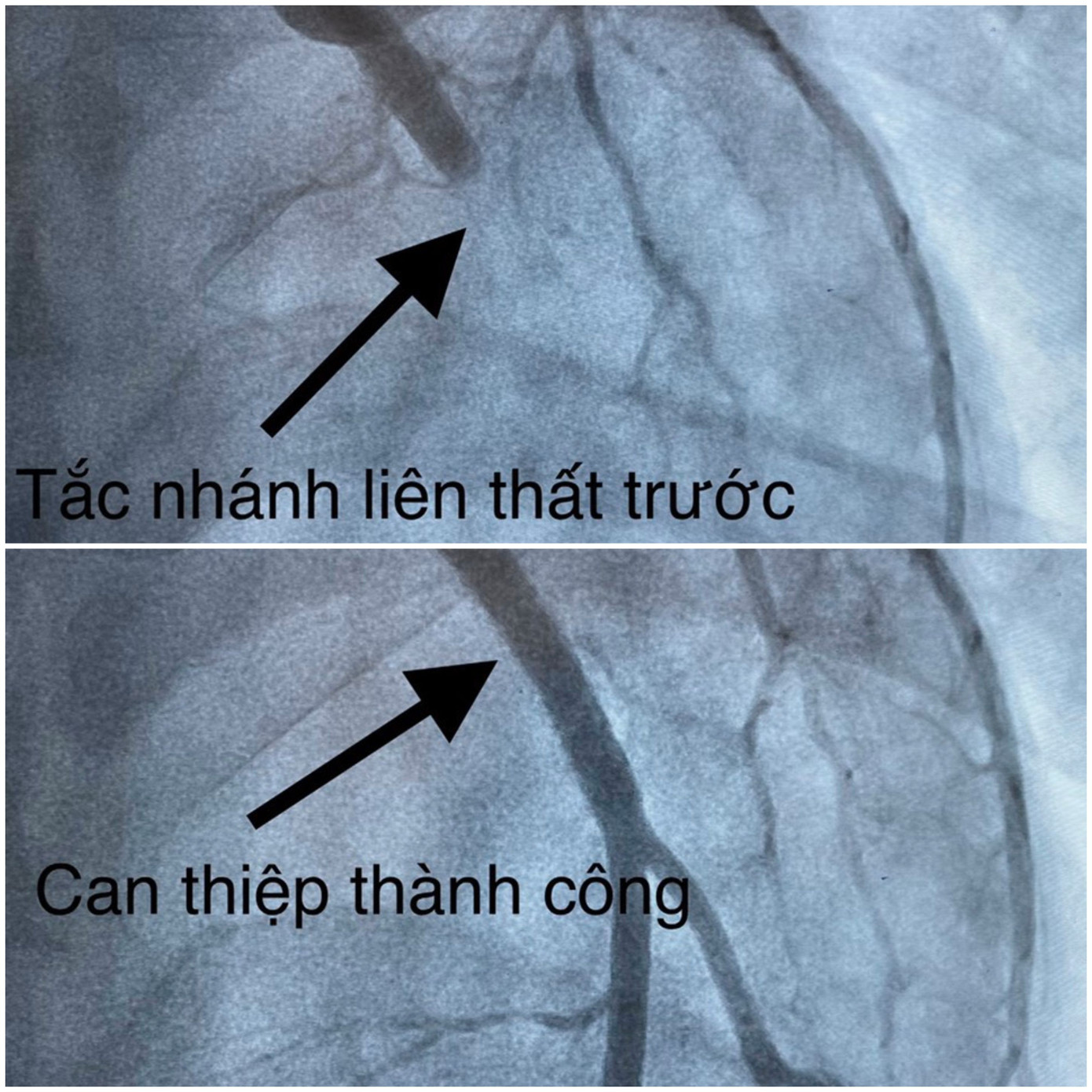 23 tuổi, nam thanh niên đột quỵ vì hút thuốc và nhậu trong nhiều năm ảnh 2