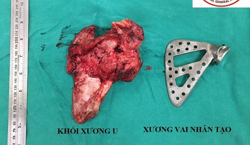 Lần đầu tiên ở Việt Nam: Thay 'vai nhân tạo' cho cô giáo mắc ung thư xương ảnh 1