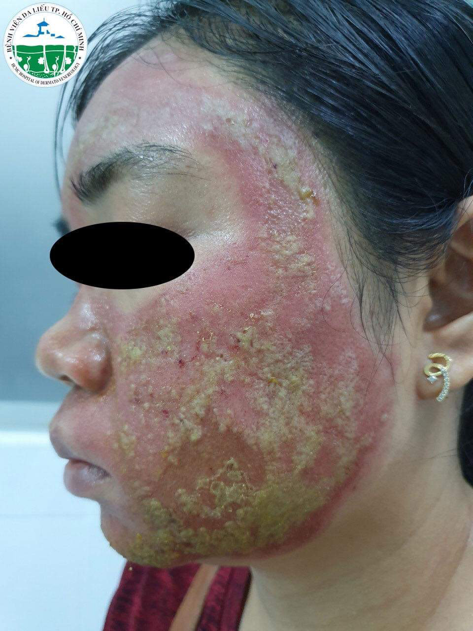 Mất 40 triệu đồng lăn kim làm đẹp, người phụ nữ rước hoạ vì mặt thành ổ mủ ảnh 1