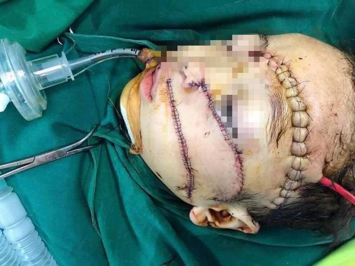 Bé trai bị bố tâm thần chém rách màng não được hỗ trợ 1,4 tỷ đồng ảnh 1