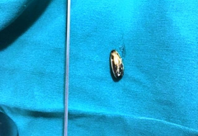 Bé trai 17 tháng tuổi hóc hạt hướng dương ở đường thở ảnh 1