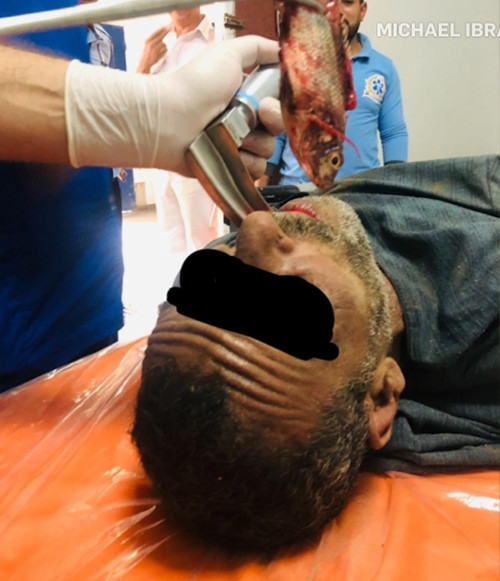 Một người bị con cá sống chui vào cổ họng suýt ngạt thở, lý do thì bạn không tin nổi đâu ảnh 1