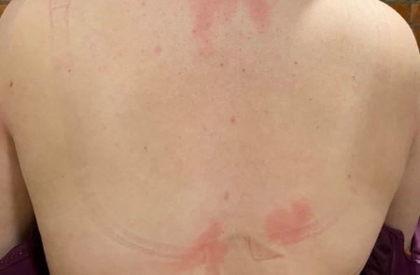 Không chịu nổi vòng 1 quá lớn, nữ sinh viên phải xin quyên góp để phẫu thuật giảm kích cỡ ảnh 2