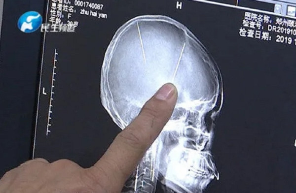Bị đập đầu nên đi kiểm tra cho chắc, choáng váng phát hiện ra 2 cái kim nằm sâu trong não ảnh 1