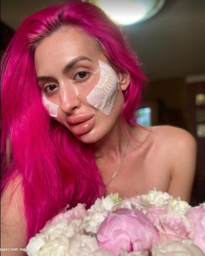 Người ta bơm vòng nọ vòng kia, riêng cô này chỉ bơm má để có “hai gò má to nhất thế giới” ảnh 4