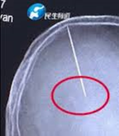 Bị đập đầu nên đi kiểm tra cho chắc, choáng váng phát hiện ra 2 cái kim nằm sâu trong não ảnh 2