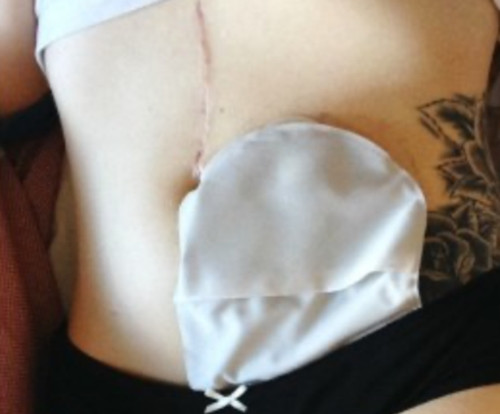 Luôn nhịn đi vệ sinh mỗi lần đi chơi với người yêu, cô gái này gặp biến chứng nghiêm trọng ảnh 2