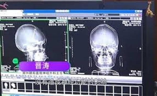 Bị đập đầu nên đi kiểm tra cho chắc, choáng váng phát hiện ra 2 cái kim nằm sâu trong não ảnh 3