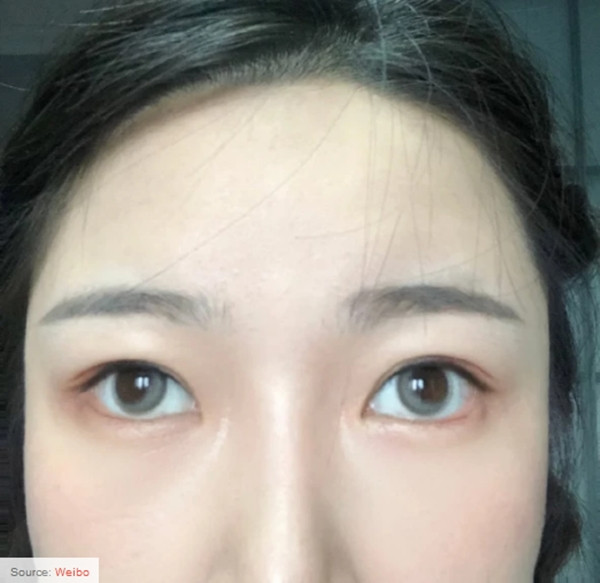 Mua kính áp tròng đang “hot” trên mạng, một loạt khách hàng kêu ca vì kính làm lệch cả mắt ảnh 4