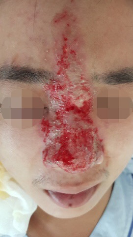 Mù mắt vì tiêm filler nâng mũi ảnh 1